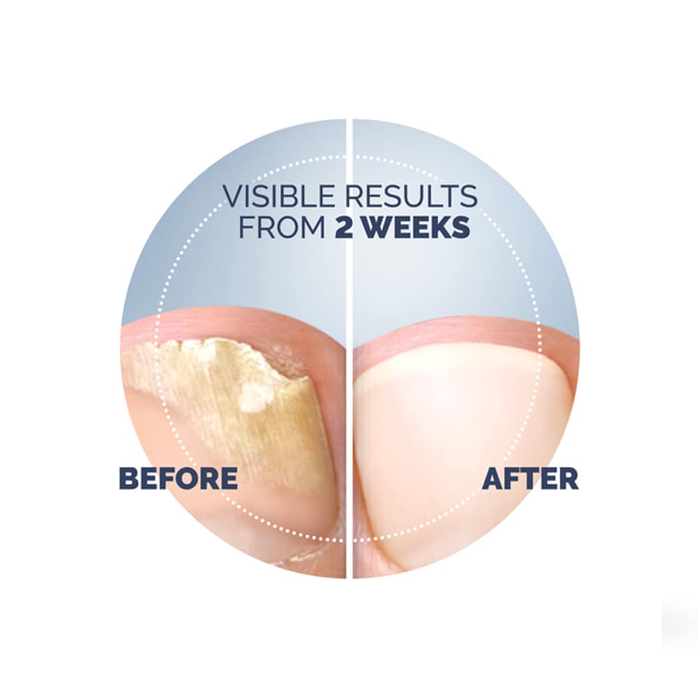 Produktbild 4 - Scholl Nagelsvampbehandling